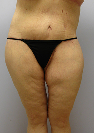 Buttock Lift Before & After Image
