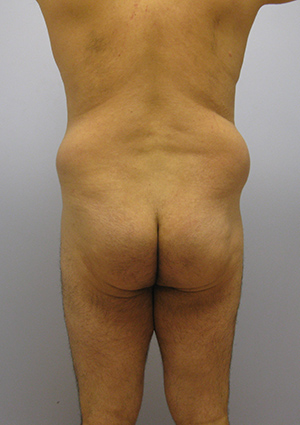 Buttock Lift Before & After Image