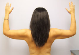 Brachioplasty Before & After Image