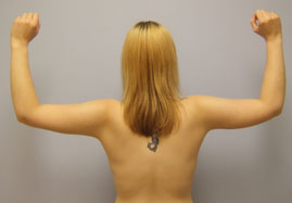 Brachioplasty Before & After Image