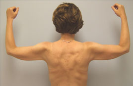 Brachioplasty Before & After Image