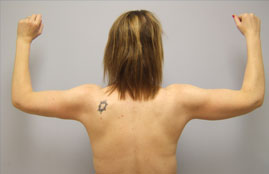 Brachioplasty Before & After Image