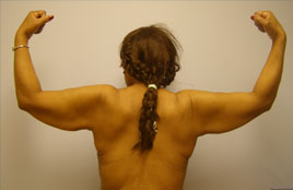 Brachioplasty Before & After Image