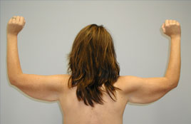 Brachioplasty Before & After Image