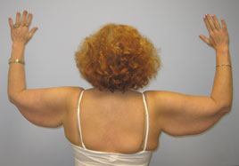 Brachioplasty Before & After Image