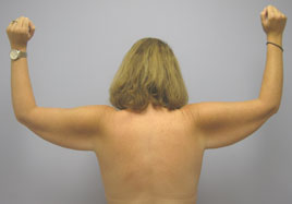 Brachioplasty Before & After Image