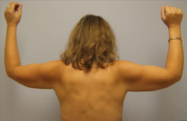 Brachioplasty Before & After Image