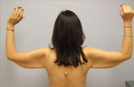 Brachioplasty Before & After Image