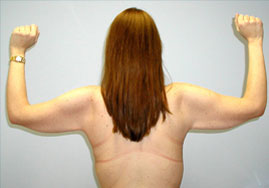 Brachioplasty Before & After Image