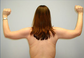 Brachioplasty Before & After Image