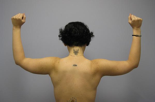 Brachioplasty Before & After Image