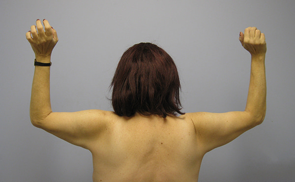 Brachioplasty Before & After Image