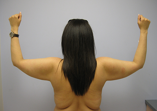 Brachioplasty Before & After Image