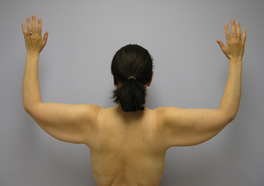 Brachioplasty Before & After Image