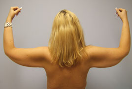 Brachioplasty Before & After Image