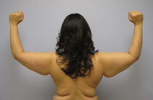 Brachioplasty Before & After Image