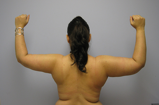 Brachioplasty Before & After Image