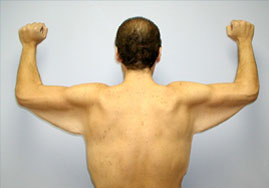 Brachioplasty Before & After Image