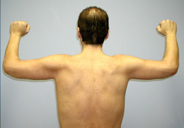 Brachioplasty Before & After Image