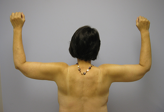 Brachioplasty Before & After Image