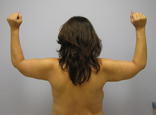 Brachioplasty Before & After Image