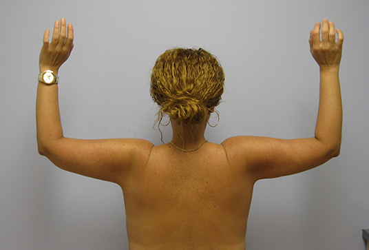 Brachioplasty Before & After Image