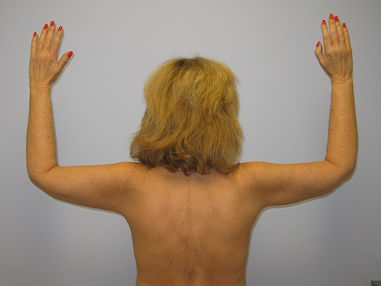 Brachioplasty Before & After Image