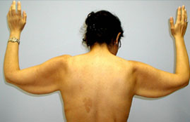 Brachioplasty Before & After Image