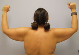 Brachioplasty Before & After Image