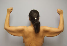 Brachioplasty Before & After Image