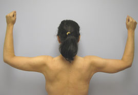 Brachioplasty Before & After Image