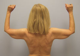 Brachioplasty Before & After Image