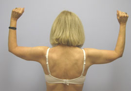 Brachioplasty Before & After Image