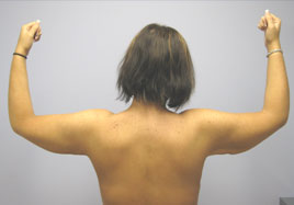 Brachioplasty Before & After Image