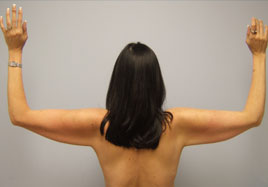 Brachioplasty Before & After Image