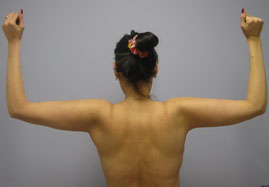 Brachioplasty Before & After Image