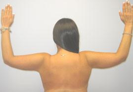 Brachioplasty Before & After Image