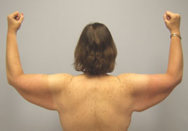 Brachioplasty Before & After Image