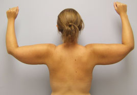 Brachioplasty Before & After Image