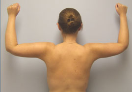 Brachioplasty Before & After Image