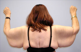 Brachioplasty Before & After Image