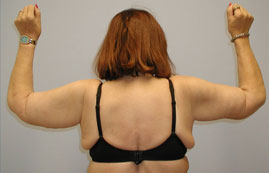 Brachioplasty Before & After Image