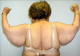 Brachioplasty Before & After Image