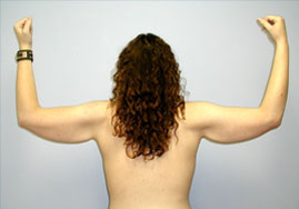 Brachioplasty Before & After Image