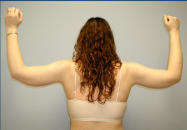 Brachioplasty Before & After Image