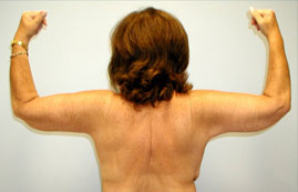 Brachioplasty Before & After Image