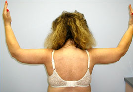 Brachioplasty Before & After Image