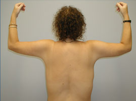 Brachioplasty Before & After Image