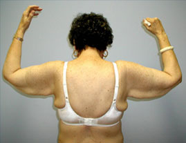 Brachioplasty Before & After Image