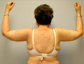 Brachioplasty Before & After Image